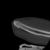 SPORK, NICO - 22.03.1976 - 02.08.2022 - CT obere Extremität - 17:59:38